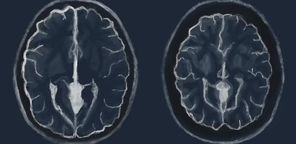 COVID-19 shrinks our brains – PM: Nothing to see here... Freedom day!